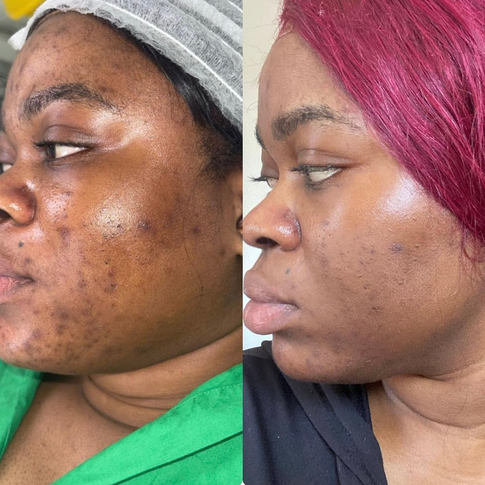Skin Transformation Result