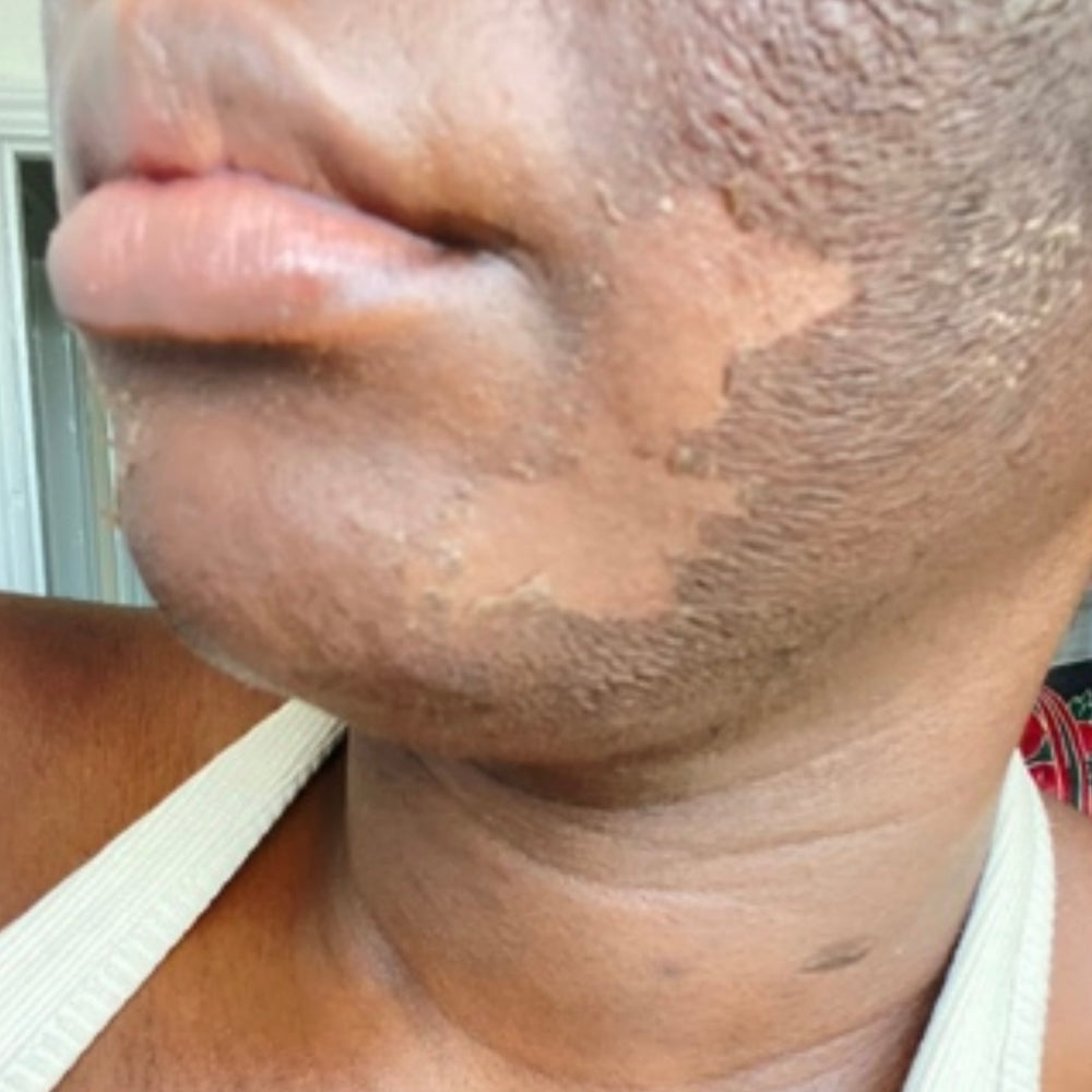 Skin Transformation Result