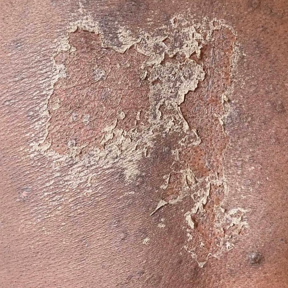 Skin Transformation Result